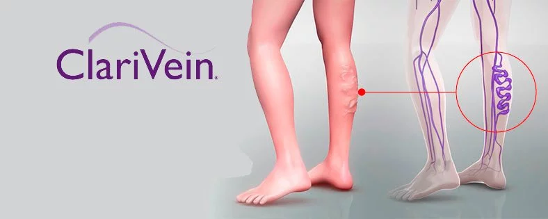 clariven para varices clinica estetica castelblanque