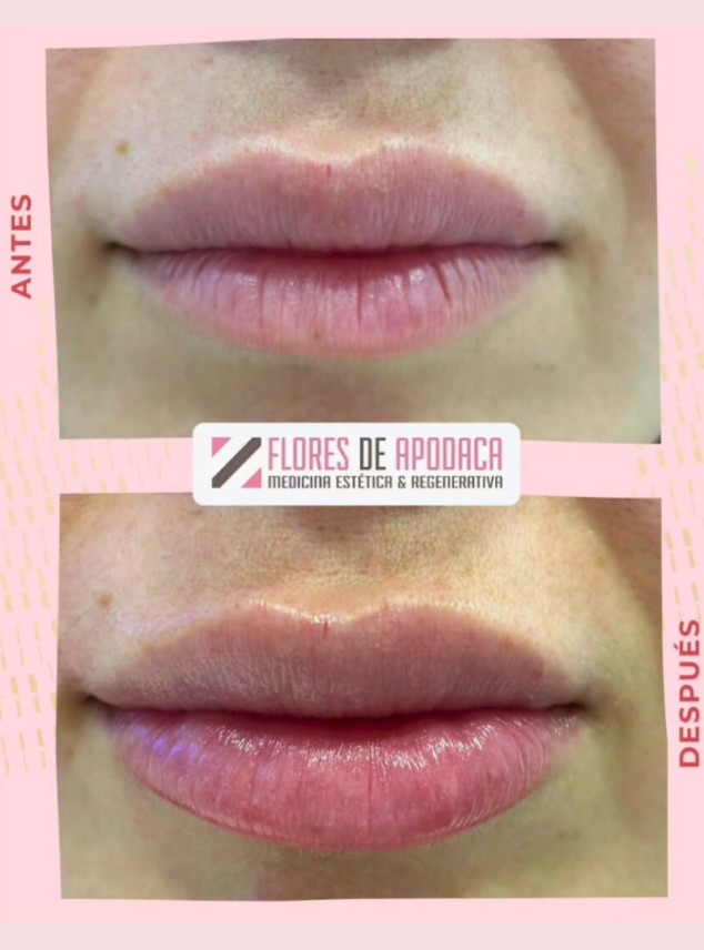 aporta volumen sutil y suavidad a tus labios con resultados personalizados